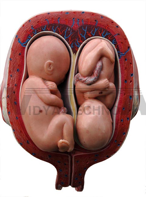 Twins In Utero